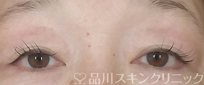 症例NO.67201のBEFORE写真