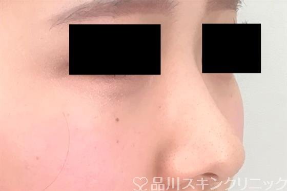 症例NO.54953のBEFORE写真