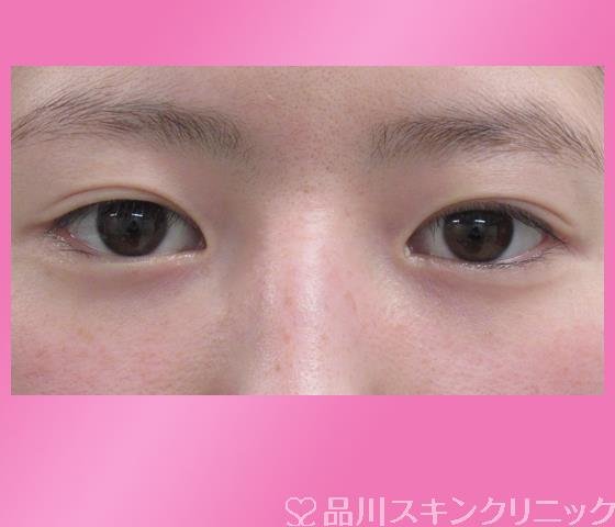 症例NO.28038のBEFORE写真