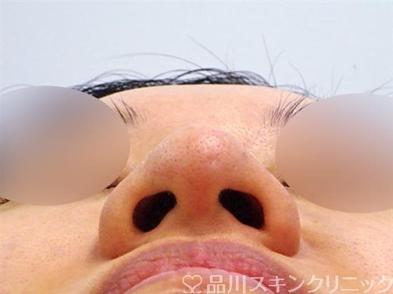 症例NO.49845のBEFORE写真