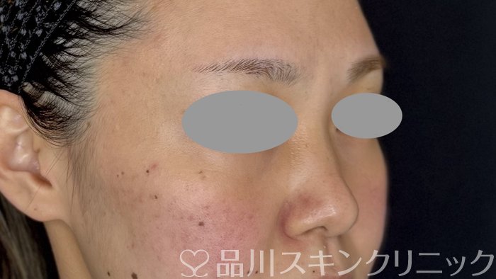 症例NO.67970のBEFORE写真