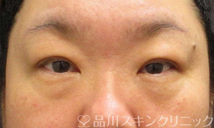 症例NO.67600のBEFORE写真