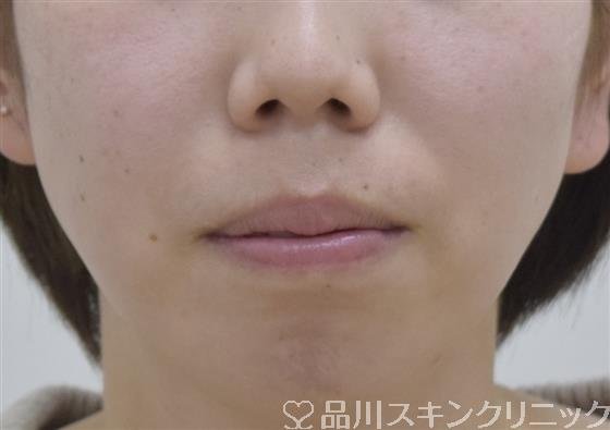 症例NO.53197のBEFORE写真