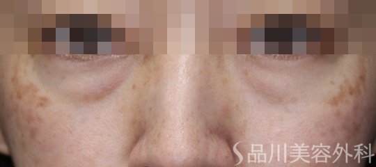 症例NO.67671のBEFORE写真