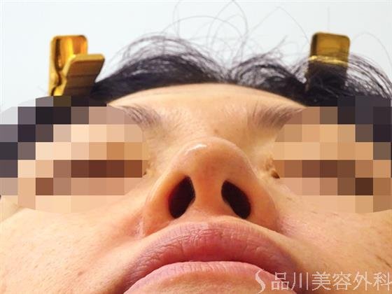 症例NO.48684のBEFORE写真