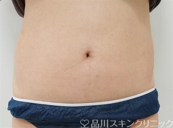 症例NO.27032のBEFORE写真