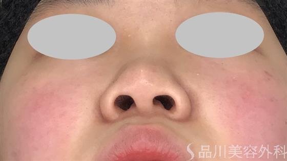 症例NO.60178のBEFORE写真