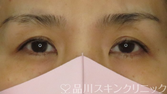 症例NO.62769のBEFORE写真