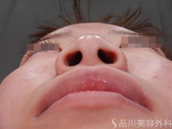 症例NO.56190のBEFORE写真