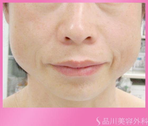 症例NO.1434のBEFORE写真