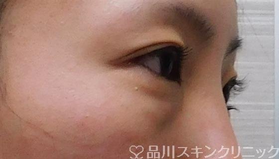 症例NO.48011のBEFORE写真