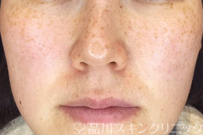 症例NO.66187のBEFORE写真