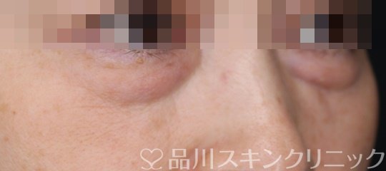 症例NO.64994のBEFORE写真