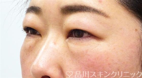 症例NO.52707のBEFORE写真