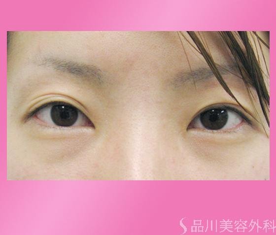 症例NO.126のBEFORE写真