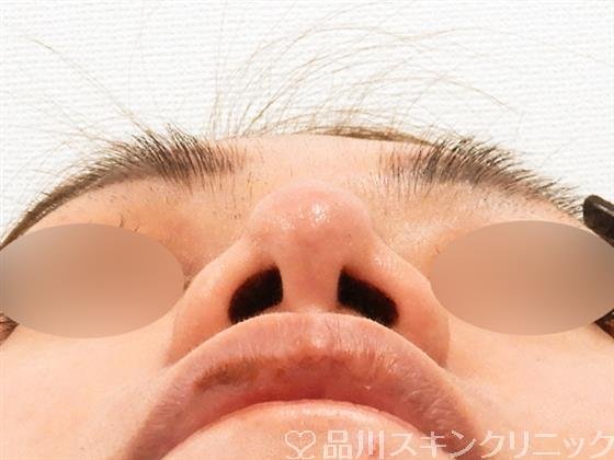 症例NO.54600のAFTER写真