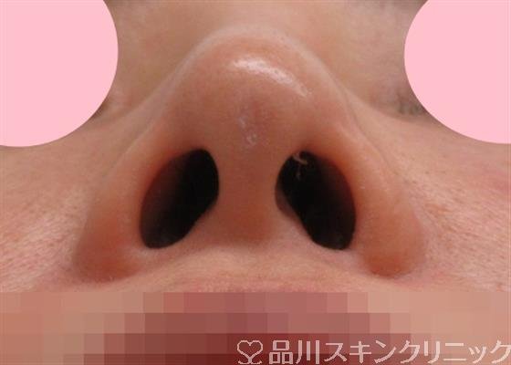 症例NO.31053のAFTER写真