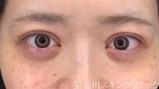 症例NO.56408のAFTER写真