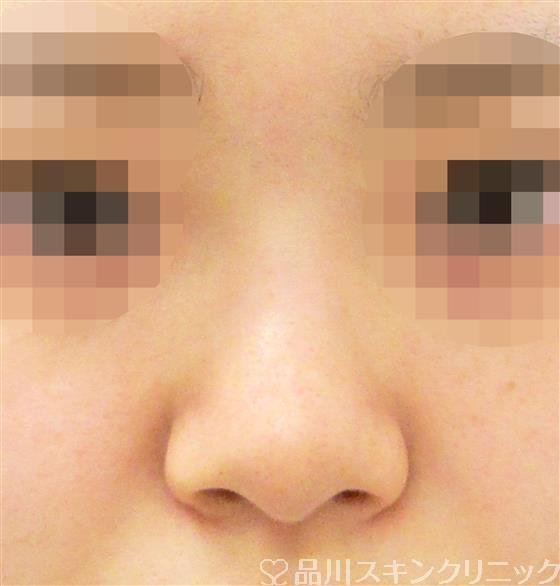 症例NO.44440のBEFORE写真