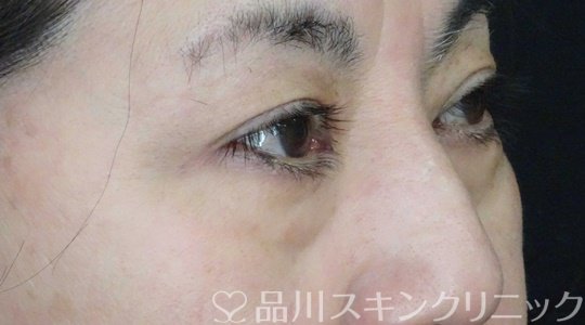 症例NO.65641のBEFORE写真