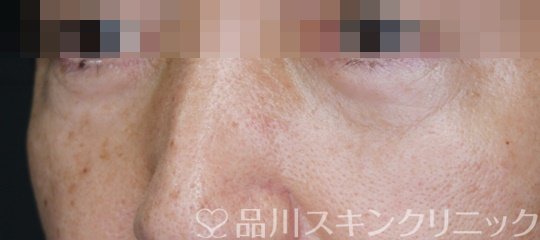 症例NO.64035のAFTER写真