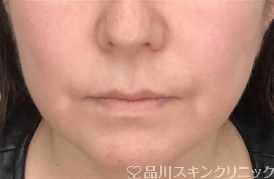 症例NO.53994のBEFORE写真