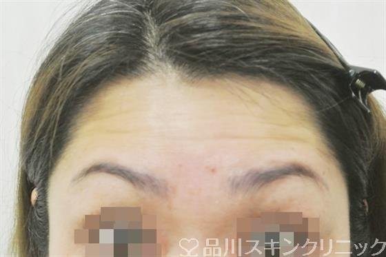 症例NO.38299のBEFORE写真