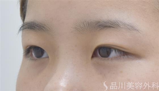 症例NO.45068のBEFORE写真