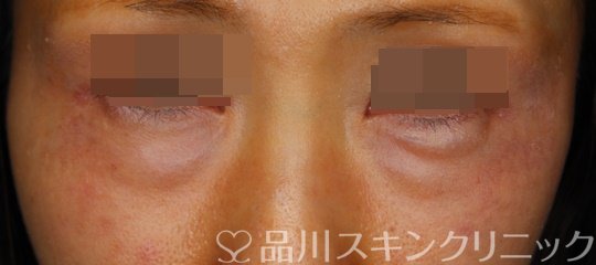 症例NO.64919のBEFORE写真