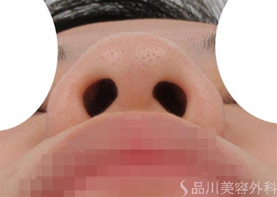 症例NO.41868のBEFORE写真