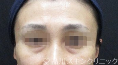 症例NO.66070のBEFORE写真