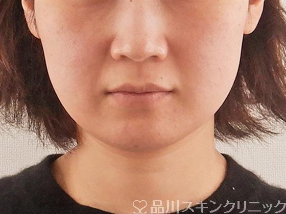 症例NO.58251のBEFORE写真