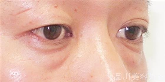 症例NO.40642のBEFORE写真