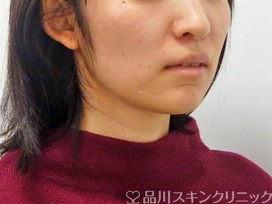 症例NO.48938のBEFORE写真