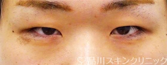 症例NO.50300のBEFORE写真