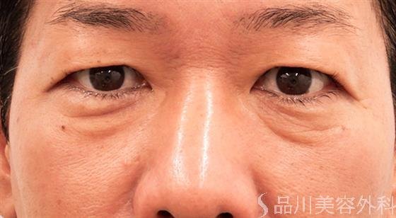 症例NO.51859のBEFORE写真