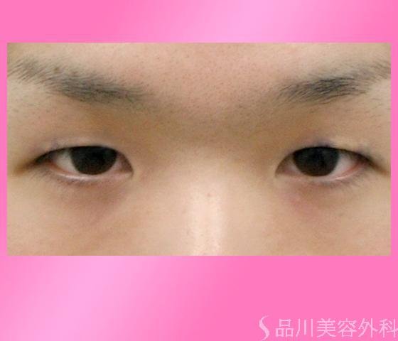 症例NO.1805のBEFORE写真