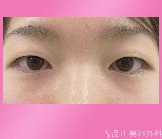 症例NO.3204のBEFORE写真