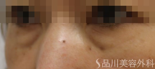 症例NO.65560のBEFORE写真