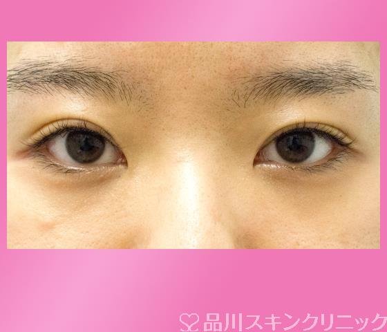 症例NO.27220のBEFORE写真