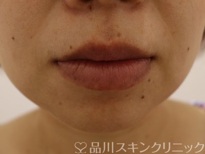 症例NO.62501のBEFORE写真