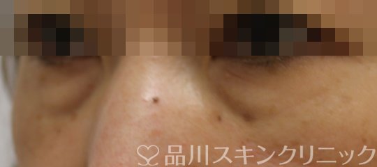 症例NO.65560のBEFORE写真