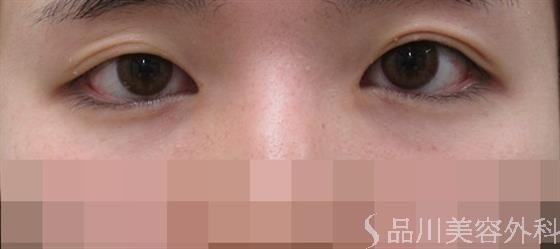 症例NO.35855のBEFORE写真