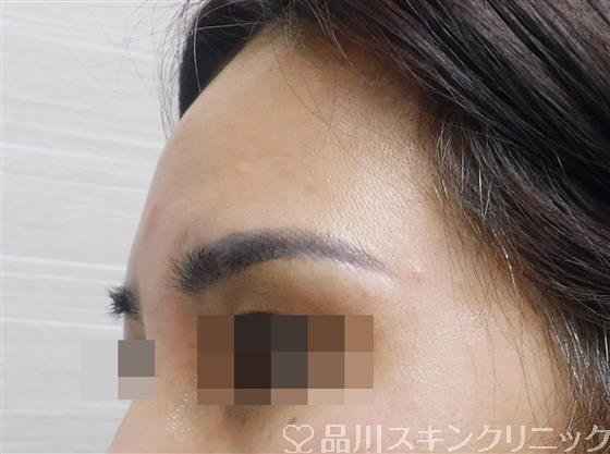 症例NO.60392のBEFORE写真