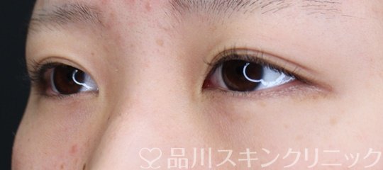 症例NO.66026のBEFORE写真