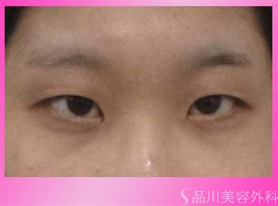 症例NO.40112のBEFORE写真