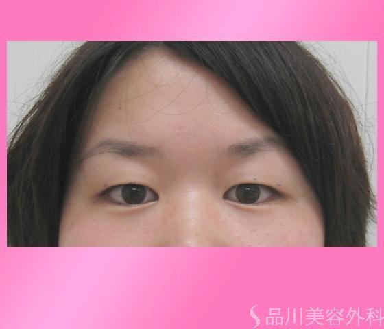 症例NO.2885のBEFORE写真