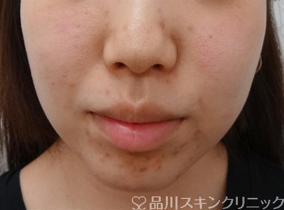 症例NO.29890のBEFORE写真