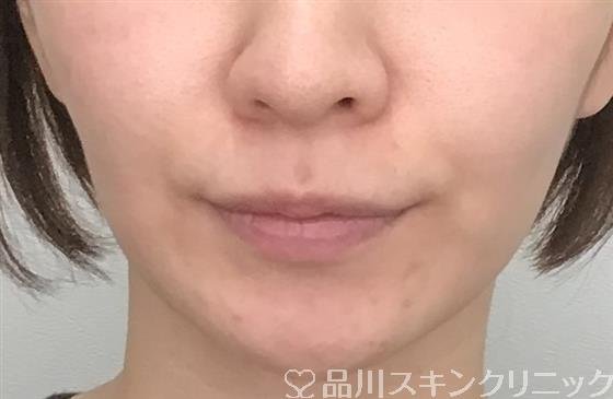 症例NO.53408のBEFORE写真